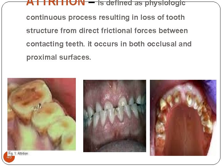 ATTRITION – is defined as physiologic continuous process resulting in loss of tooth structure ATTRITION – is defined as physiologic continuous process resulting in loss of tooth structure