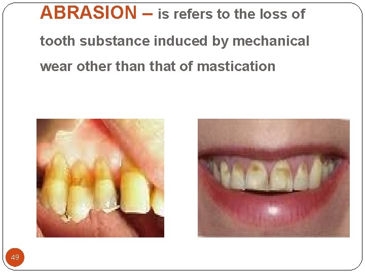 ABRASION – is refers to the loss of tooth substance induced by mechanical wear ABRASION – is refers to the loss of tooth substance induced by mechanical wear