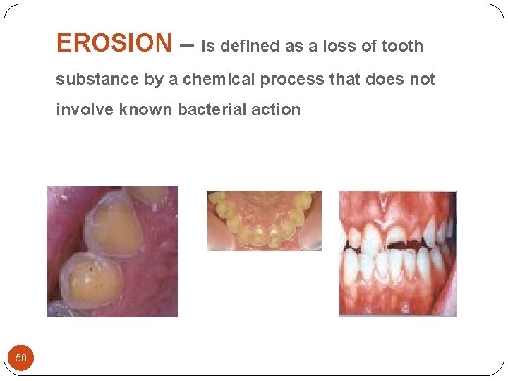 EROSION – is defined as a loss of tooth substance by a chemical process EROSION – is defined as a loss of tooth substance by a chemical process