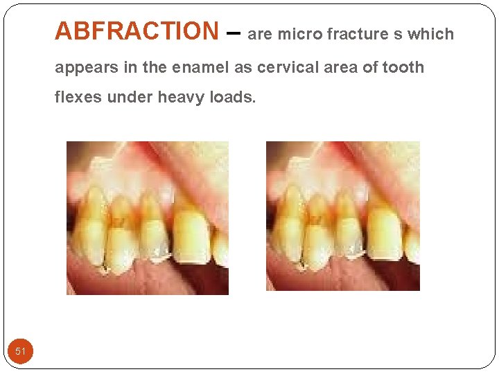 ABFRACTION – are micro fracture s which appears in the enamel as cervical area ABFRACTION – are micro fracture s which appears in the enamel as cervical area