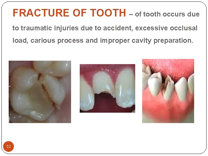 FRACTURE OF TOOTH – of tooth occurs due to traumatic injuries due to accident, FRACTURE OF TOOTH – of tooth occurs due to traumatic injuries due to accident,