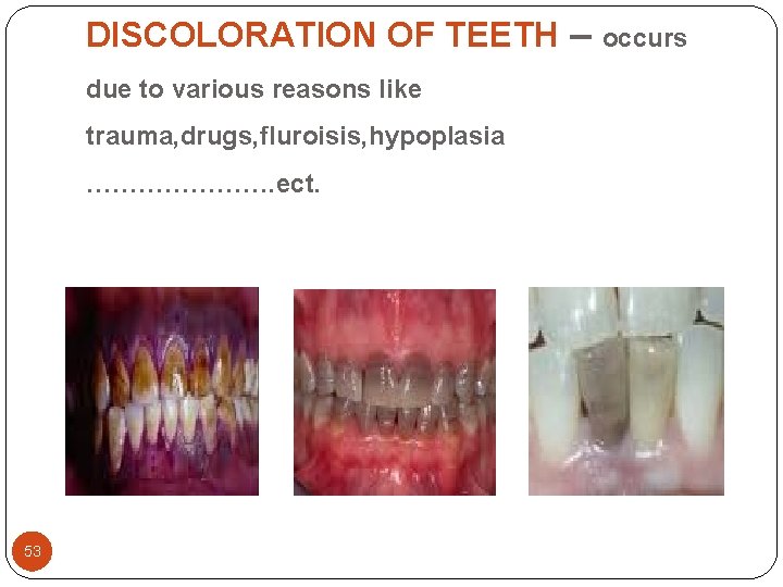 DISCOLORATION OF TEETH – due to various reasons like trauma, drugs, fluroisis, hypoplasia …………………. DISCOLORATION OF TEETH – due to various reasons like trauma, drugs, fluroisis, hypoplasia ………………….