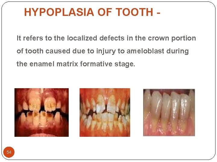 HYPOPLASIA OF TOOTH It refers to the localized defects in the crown portion of HYPOPLASIA OF TOOTH It refers to the localized defects in the crown portion of