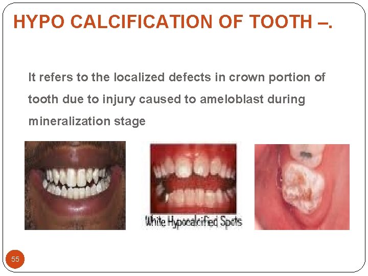HYPO CALCIFICATION OF TOOTH –. It refers to the localized defects in crown portion HYPO CALCIFICATION OF TOOTH –. It refers to the localized defects in crown portion