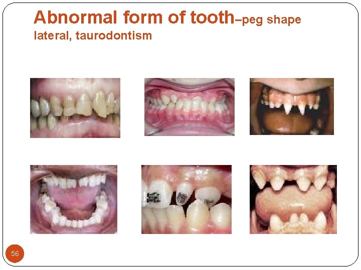 Abnormal form of tooth–peg shape lateral, taurodontism 56 Abnormal form of tooth–peg shape lateral, taurodontism 56