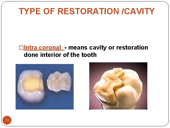 TYPE OF RESTORATION /CAVITY �Intra coronal - means cavity or restoration done interior of TYPE OF RESTORATION /CAVITY �Intra coronal - means cavity or restoration done interior of