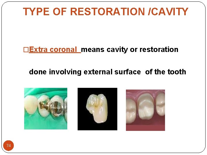 TYPE OF RESTORATION /CAVITY �Extra coronal means cavity or restoration done involving external surface TYPE OF RESTORATION /CAVITY �Extra coronal means cavity or restoration done involving external surface