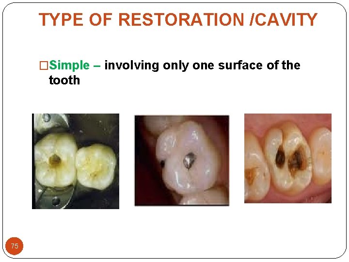 TYPE OF RESTORATION /CAVITY �Simple – involving only one surface of the tooth 75 TYPE OF RESTORATION /CAVITY �Simple – involving only one surface of the tooth 75