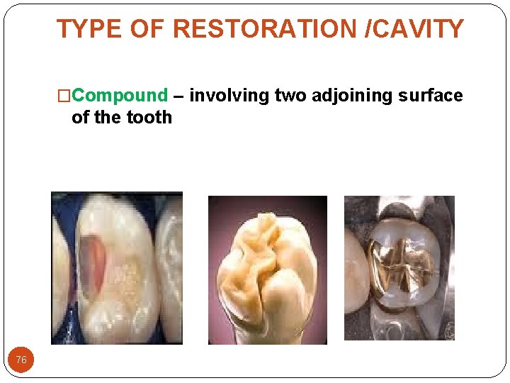 TYPE OF RESTORATION /CAVITY �Compound – involving two adjoining surface of the tooth 76 TYPE OF RESTORATION /CAVITY �Compound – involving two adjoining surface of the tooth 76