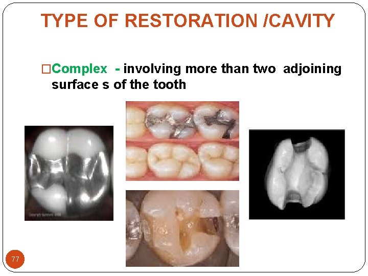 TYPE OF RESTORATION /CAVITY �Complex - involving more than two adjoining surface s of TYPE OF RESTORATION /CAVITY �Complex - involving more than two adjoining surface s of