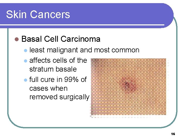 Skin Cancers l Basal Cell Carcinoma least malignant and most common l affects cells