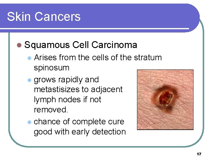 Skin Cancers l Squamous Cell Carcinoma Arises from the cells of the stratum spinosum