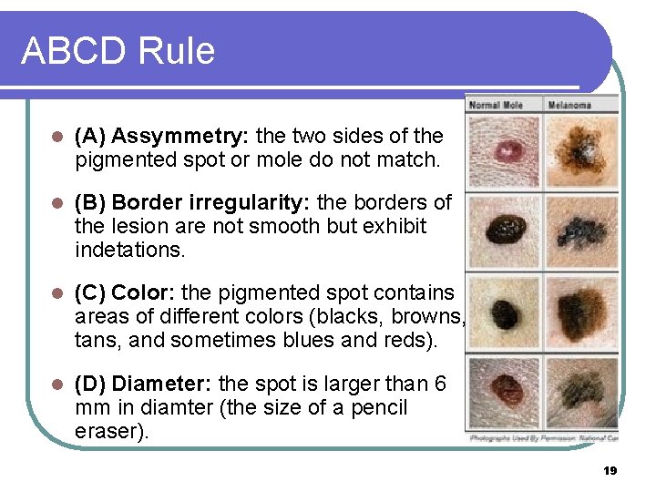 ABCD Rule l (A) Assymmetry: the two sides of the pigmented spot or mole