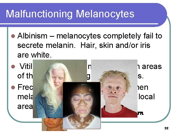 Malfunctioning Melanocytes l Albinism – melanocytes completely fail to secrete melanin. Hair, skin and/or