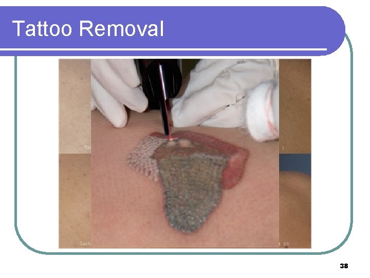 Tattoo Removal 38 