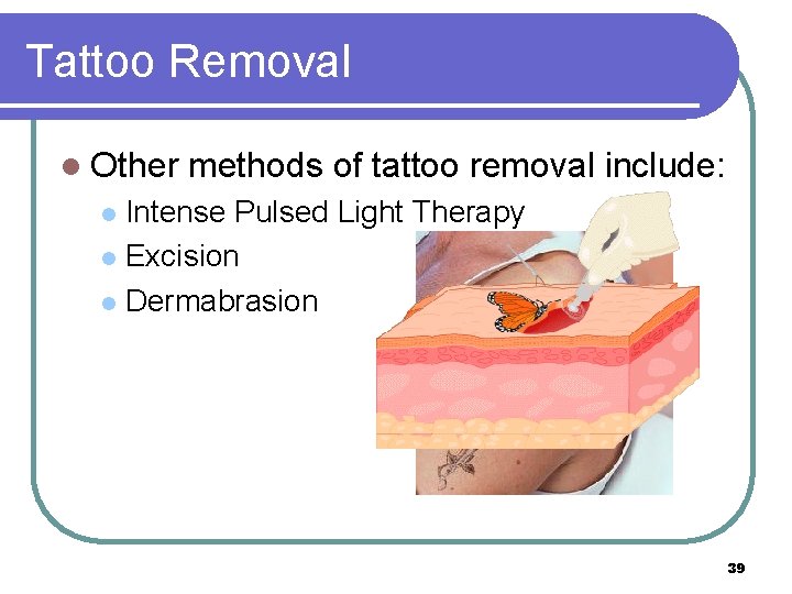 Tattoo Removal l Other methods of tattoo removal include: Intense Pulsed Light Therapy l