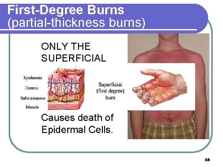 First-Degree Burns (partial-thickness burns) ONLY THE SUPERFICIAL EPIDERMIS IS BURNED, AND IS PAINFUL BUT