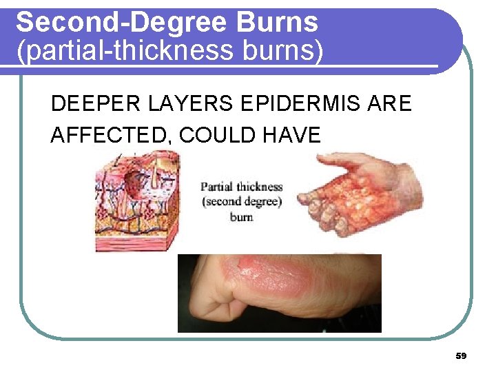 Second-Degree Burns (partial-thickness burns) DEEPER LAYERS EPIDERMIS ARE AFFECTED, COULD HAVE INFLAMMATION, BLISTERS, AND