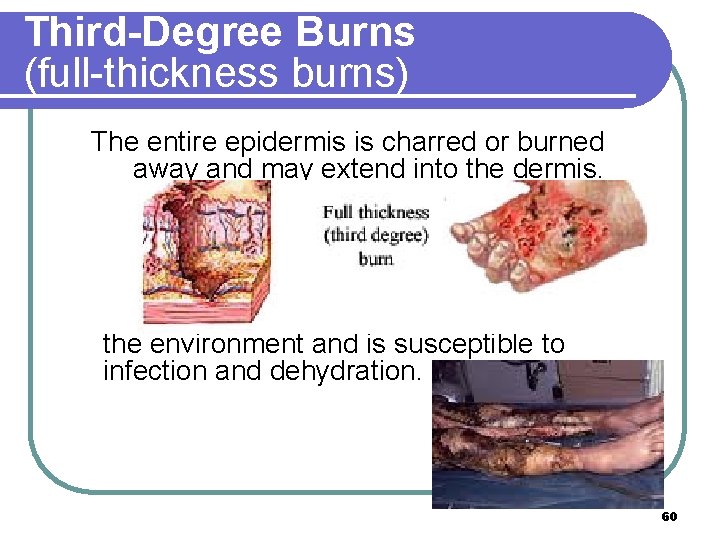 Third-Degree Burns (full-thickness burns) The entire epidermis is charred or burned away and may