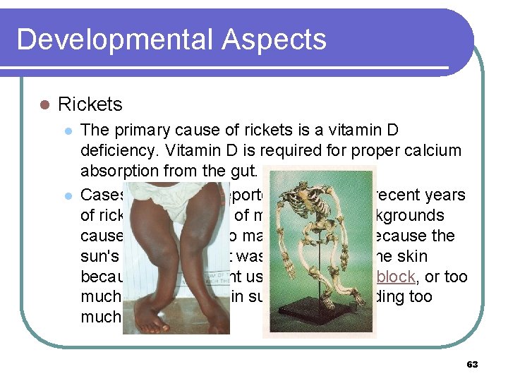 Developmental Aspects l Rickets l l The primary cause of rickets is a vitamin