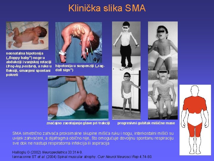 Klinička slika SMA neonatalna hipotonija („floppy baby”) noge u abdukciji i vanjskoj rotaciji (frog-leg