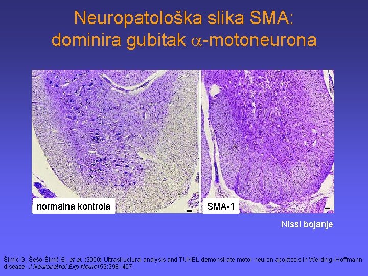 Neuropatološka slika SMA: dominira gubitak -motoneurona normalna kontrola SMA-1 Nissl bojanje Šimić G, Šešo-Šimić