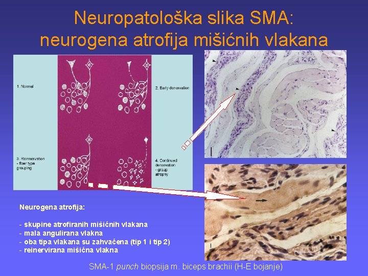 Neuropatološka slika SMA: neurogena atrofija mišićnih vlakana Neurogena atrofija: - skupine atrofiranih mišićnih vlakana