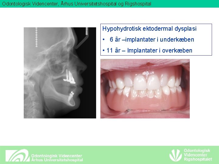 Odontologisk Videncenter, Århus Universitetshospital og Rigshospital Hypohydrotisk ektodermal dysplasi • 6 år –implantater i