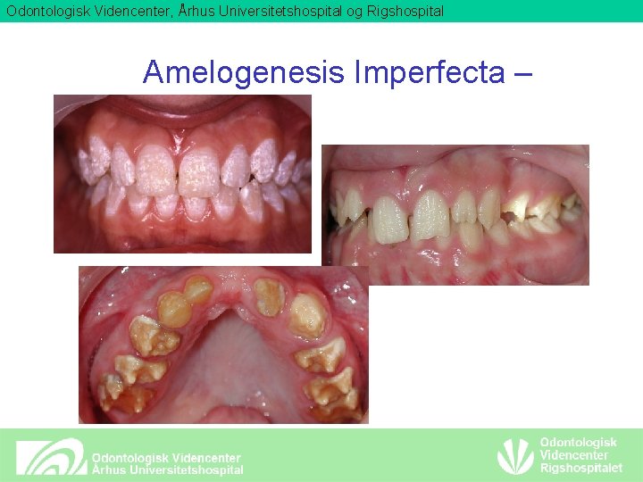 Odontologisk Videncenter, Århus Universitetshospital og Rigshospital Amelogenesis Imperfecta – 