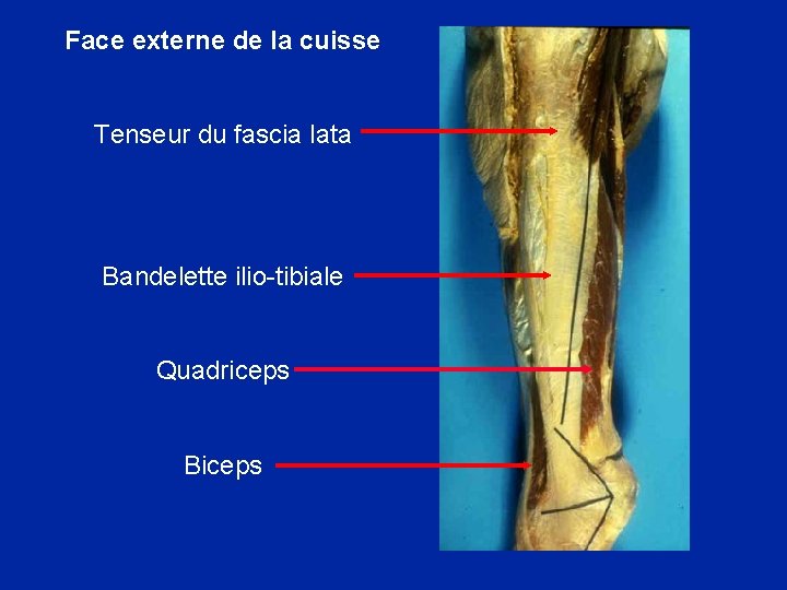 Face externe de la cuisse Tenseur du fascia lata Bandelette ilio-tibiale Quadriceps Biceps 