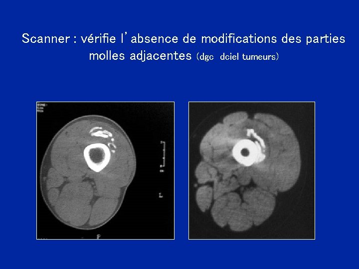 Scanner : vérifie l’absence de modifications des parties molles adjacentes (dgc dciel tumeurs) 