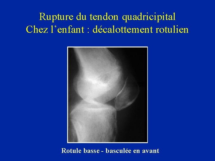 Rupture du tendon quadricipital Chez l’enfant : décalottement rotulien Rotule basse - basculée en