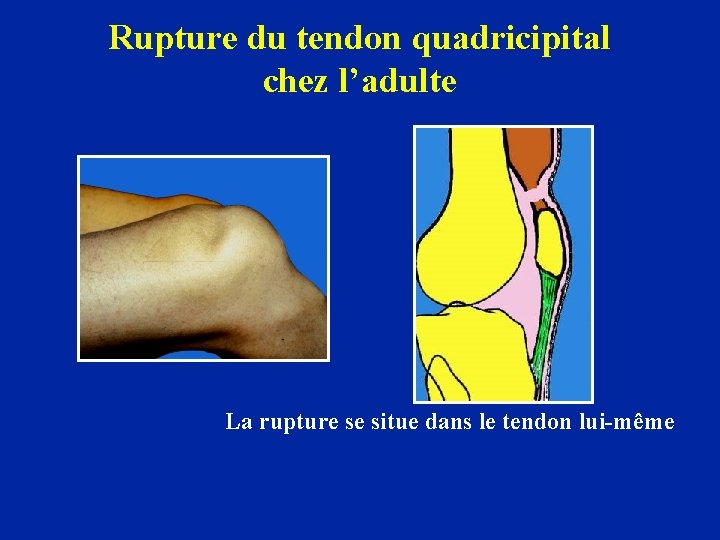 Rupture du tendon quadricipital chez l’adulte La rupture se situe dans le tendon lui-même