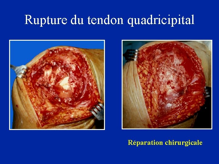 Rupture du tendon quadricipital Réparation chirurgicale 
