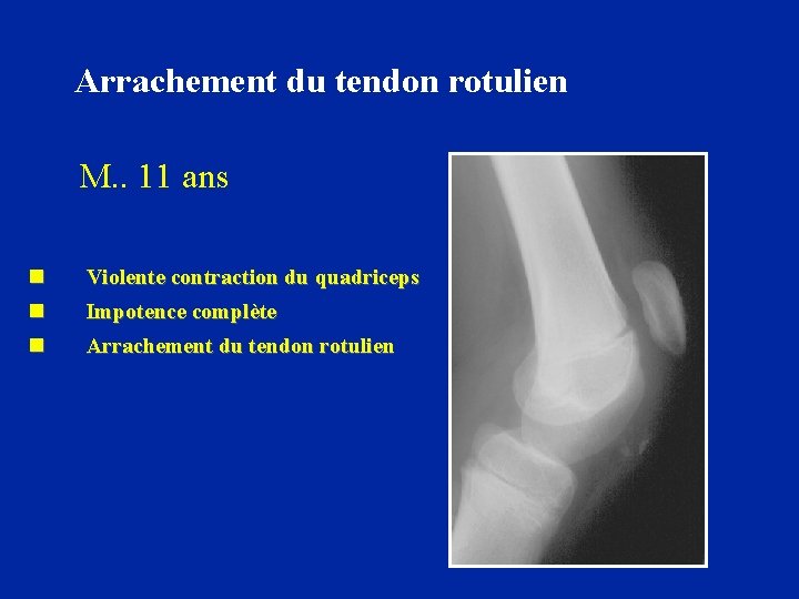 Arrachement du tendon rotulien M. . 11 ans n n Violente contraction du quadriceps