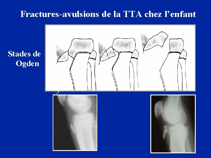 Fractures-avulsions de la TTA chez l’enfant Stades de Ogden Type 1 3 Type 2