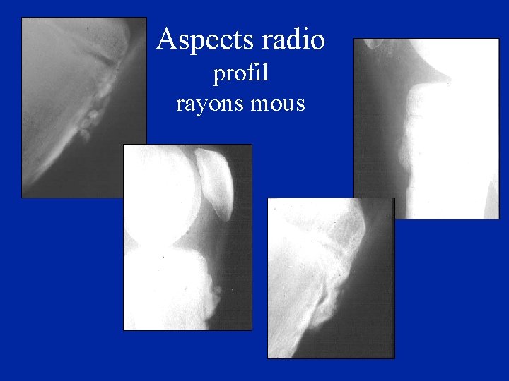 Aspects radio profil rayons mous 