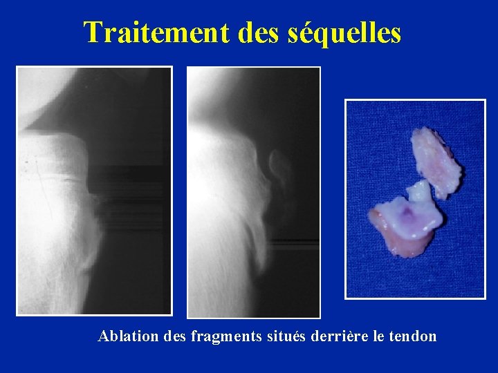 Traitement des séquelles Ablation des fragments situés derrière le tendon 