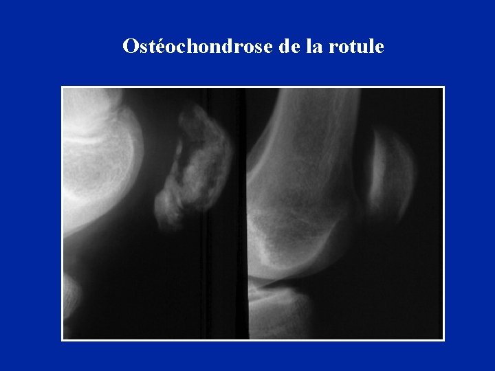 Ostéochondrose de la rotule 