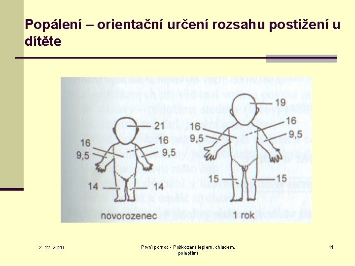 Popálení – orientační určení rozsahu postižení u dítěte 2. 12. 2020 První pomoc -