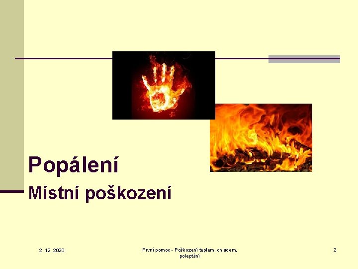 Popálení Místní poškození 2. 12. 2020 První pomoc - Poškození teplem, chladem, poleptání 2