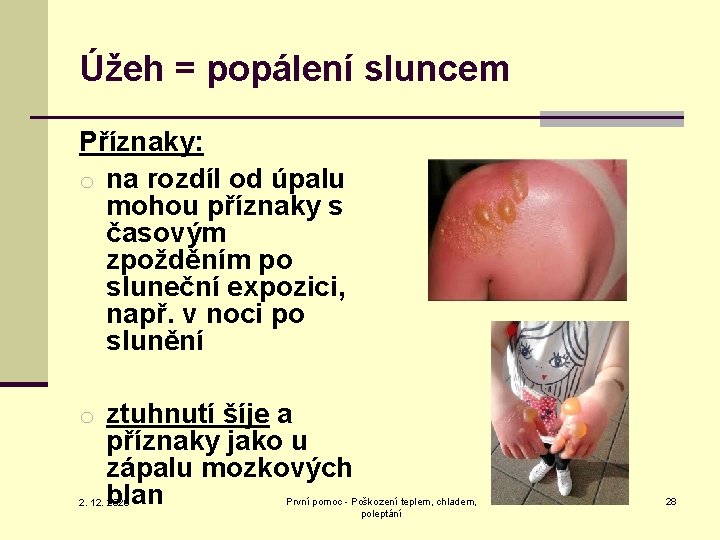 Úžeh = popálení sluncem Příznaky: o na rozdíl od úpalu mohou příznaky s časovým