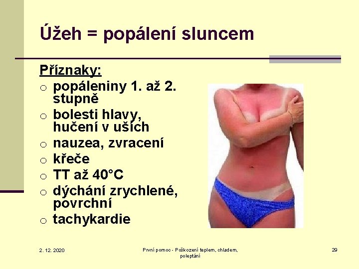 Úžeh = popálení sluncem Příznaky: o popáleniny 1. až 2. stupně o bolesti hlavy,