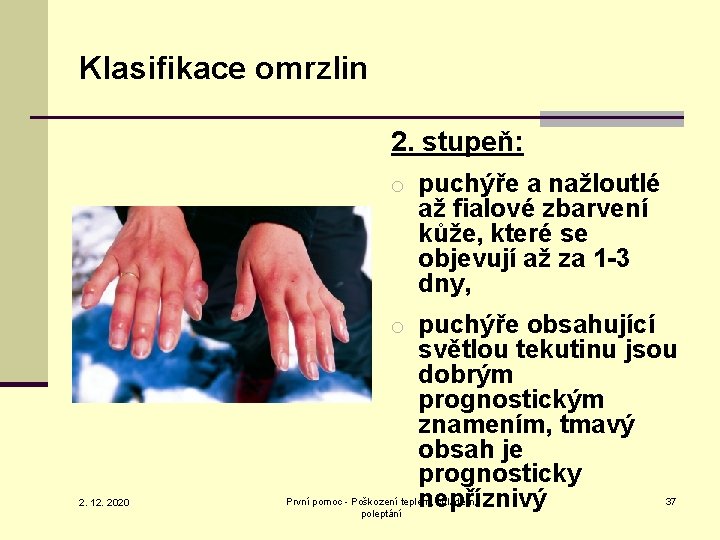 Klasifikace omrzlin 2. stupeň: o puchýře a nažloutlé až fialové zbarvení kůže, které se