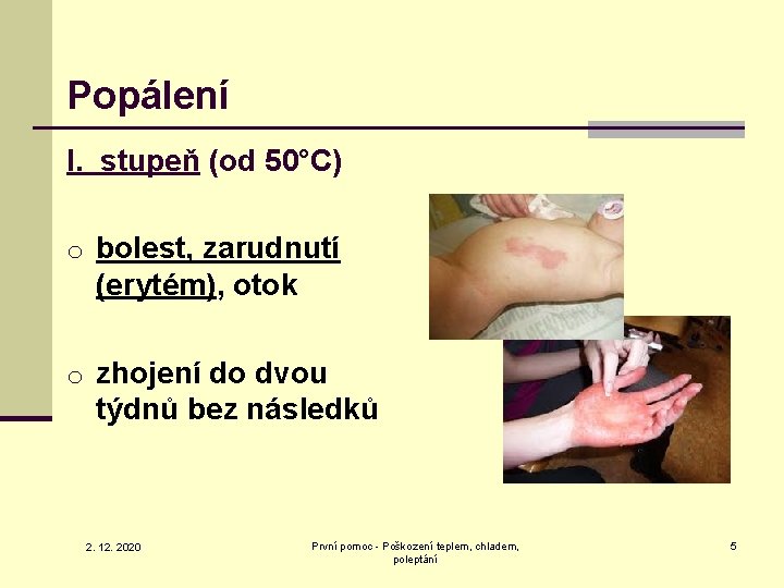 Popálení I. stupeň (od 50°C) o bolest, zarudnutí (erytém), otok o zhojení do dvou