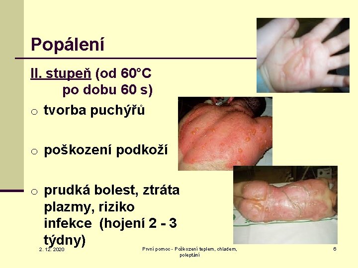 Popálení II. stupeň (od 60°C po dobu 60 s) o tvorba puchýřů o poškození