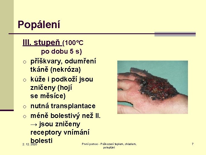 Popálení III. stupeň (100°C po dobu 5 s) o příškvary, odumření tkáně (nekróza) o