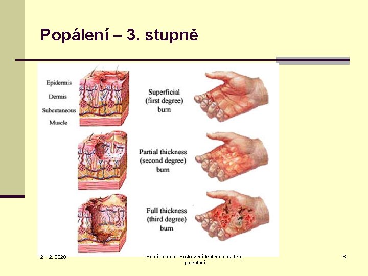 Popálení – 3. stupně 2. 12. 2020 První pomoc - Poškození teplem, chladem, poleptání