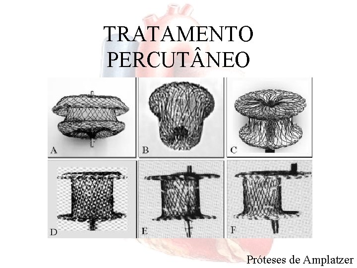 TRATAMENTO PERCUT NEO Próteses de Amplatzer 