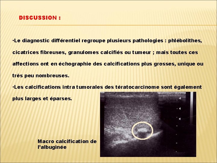 DISCUSSION : • Le diagnostic différentiel regroupe plusieurs pathologies : phlébolithes, cicatrices fibreuses, granulomes